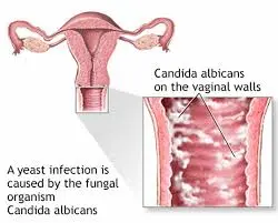 Candida Infections: Clinical Features, Diagnosis and Treatment